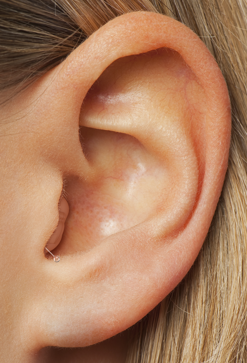 Spot Mini 6 Hearing Aid - In Ear Example